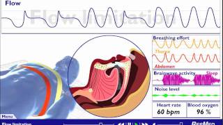 Understanding Sleep Disordered Breathing [upl. by Sherie]