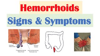 Hemorrhoids Signs amp Symptoms  Internal vs External Hemorrhoid Symptoms  Hemorrhoidal Disease [upl. by Soinotna903]