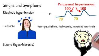 Pheochromocytoma amp Paraganglioma What Every Endocrinologist amp Physician Needs to Know [upl. by Uol]