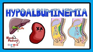 Hypoalbuminemia  Functions of Albumin in the Body  Pathophysiology of Hypoalbuminemia [upl. by Hereld]