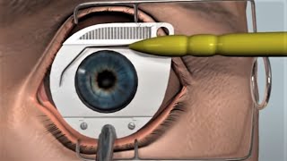 LASIK eye surgery  3D animation [upl. by Ardnuyek]