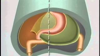 Peritoneum and Mesentery  Carsinomatosis  MRI Online [upl. by Zaria]