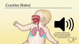 Approach to Pediatric Chest XRays [upl. by Ummersen]