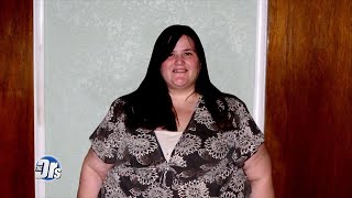 Watch Skin Removal Surgery for Woman that Lost 280 Pounds [upl. by Wanids877]