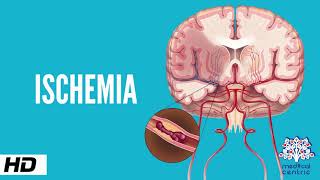 Ischemic Heart Disease in under 2 mins [upl. by Niveb]