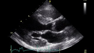 PVC Echo Parasternal Long Axis View  Aortic Stenosis [upl. by Claudetta]