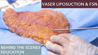 The Science Behind Vaser Liposuction How Does It Work [upl. by Creight]