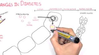 Diabetes mellitus type 1 type 2 amp diabetic ketoacidosis DKA [upl. by Pomona]