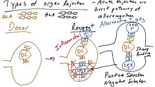 Treatment of Corneal Transplant rejection  Dr Mala Suresh [upl. by Somerset]