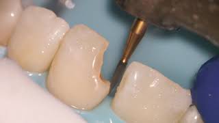 Teeth Bonding  Front tooth filling EXPLAINED [upl. by Farl]