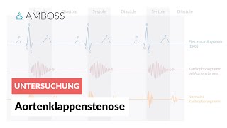 Aortenklappenstenose  Herzgeräusch  AMBOSS Video [upl. by Enyalaj485]