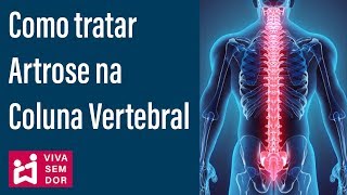 Como prevenir e tratar artrose na coluna vertebral [upl. by Yrelbmik761]