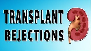 Kidney Transplants [upl. by Ruford273]