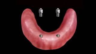 Proteza overdenture na 2 implantach [upl. by Yeclek]