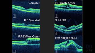 Macular OCT Interpretation A Practical Discussion with Dr David E Lederer [upl. by Nonaihr]