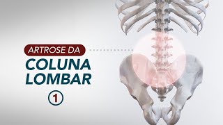 Artrose da coluna O que é e como diagnosticar [upl. by Stanislaus713]